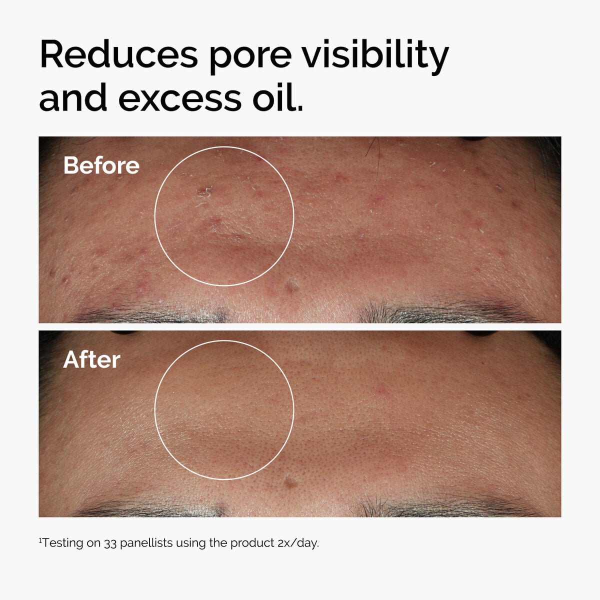 niacinamide-10-zinc-1-z5 ord-niacinamide-zinc-blemish-serum-before-after-pores.jpg