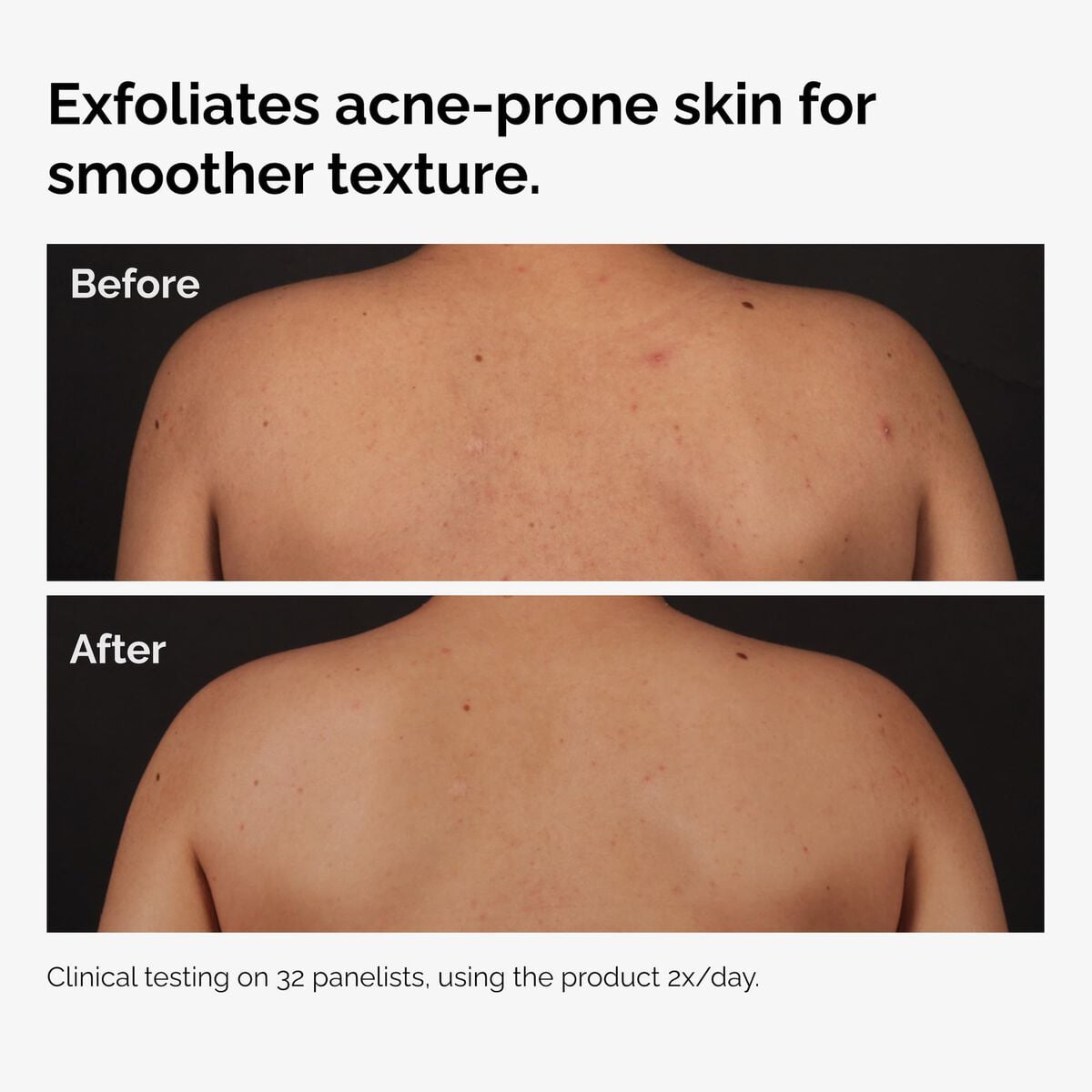 salicylic-acid-0-5-body-serum-k9 ord-salicylic-acid-body-serum-before-after-graphic-NA.jpg