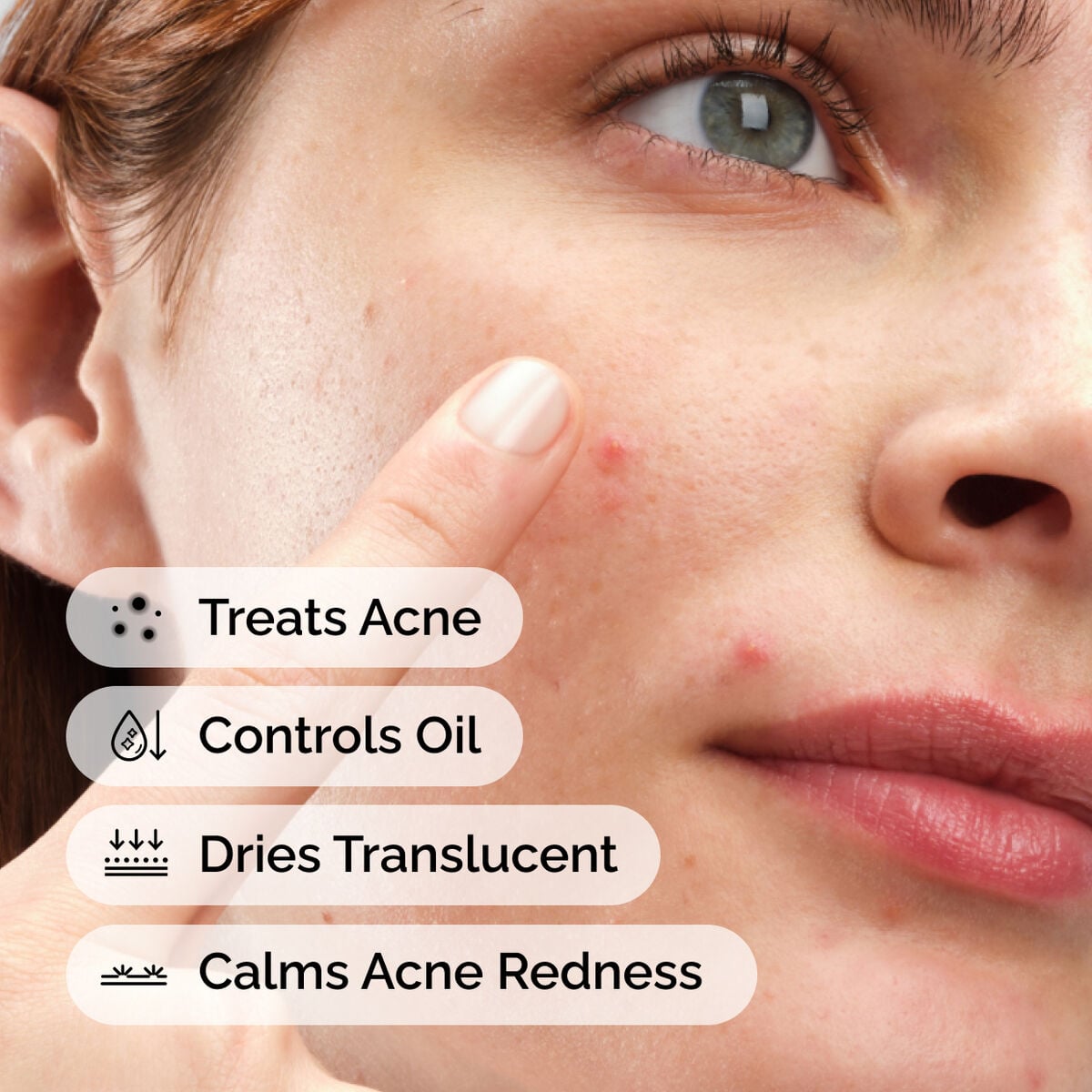 sulfur-10-powder-to-cream-concentrate-n0 ord-sulfur-10pct-powder-to-cream-concentrate-model-application-with-benefits-acne.jpg
