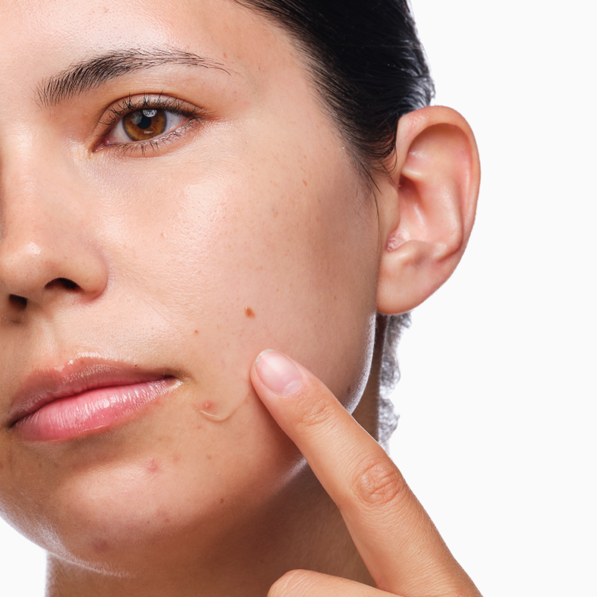 the-acne-set-n2 rdn-the-acne-set-application.png